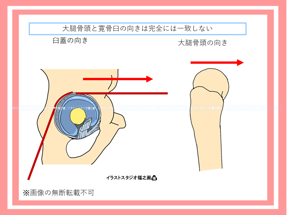 大腿骨頭と寛骨臼の向きは完全には一致しない
