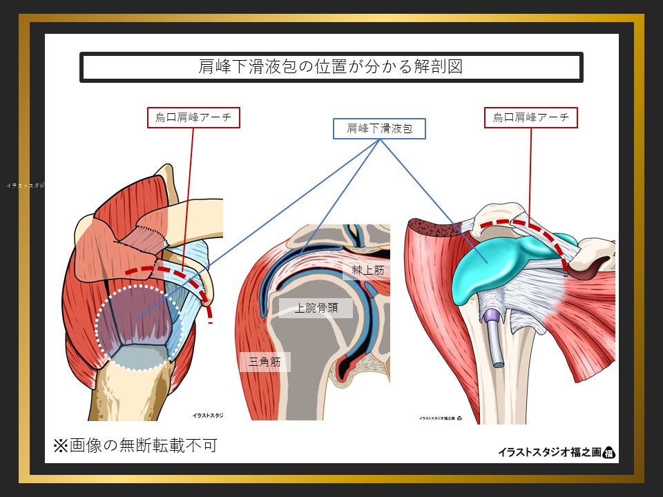 肩峰下滑液包の位置が分かる解剖図・イラスト:肩峰・上腕骨頭・第2肩関節
