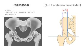 臼蓋形成不全と股関節可動域制限｜筋短縮だけで見ない評価のポイント