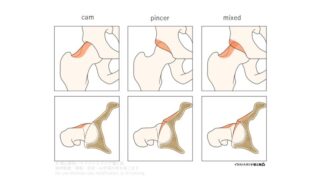 股関節インピンジメントにおけるcam形態・pincer形態と疼痛評価の考え方