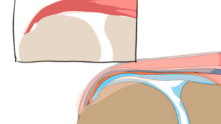 【局所解剖イラスト】棘上筋腱部分断裂の制作過程を紹介